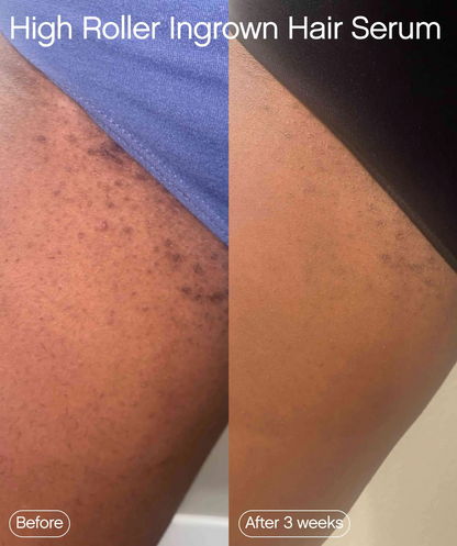 High Roller Ingrown Hair Tonic